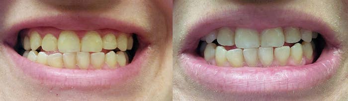 reviewer before and after photo of yellow teeth and less yellow teeth after using the pen