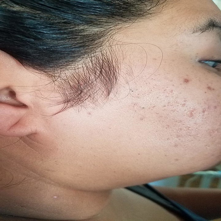 same reviewer's cheek smooth with no hair after using the remover