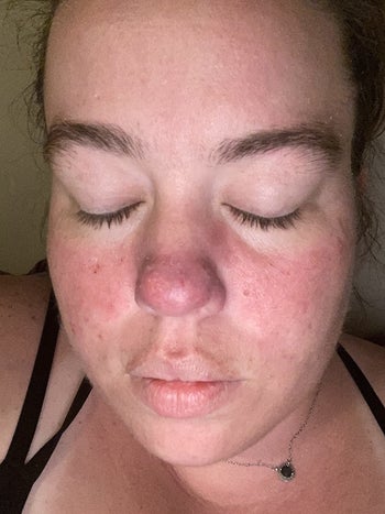 the same reviewer with skin that's no longer red