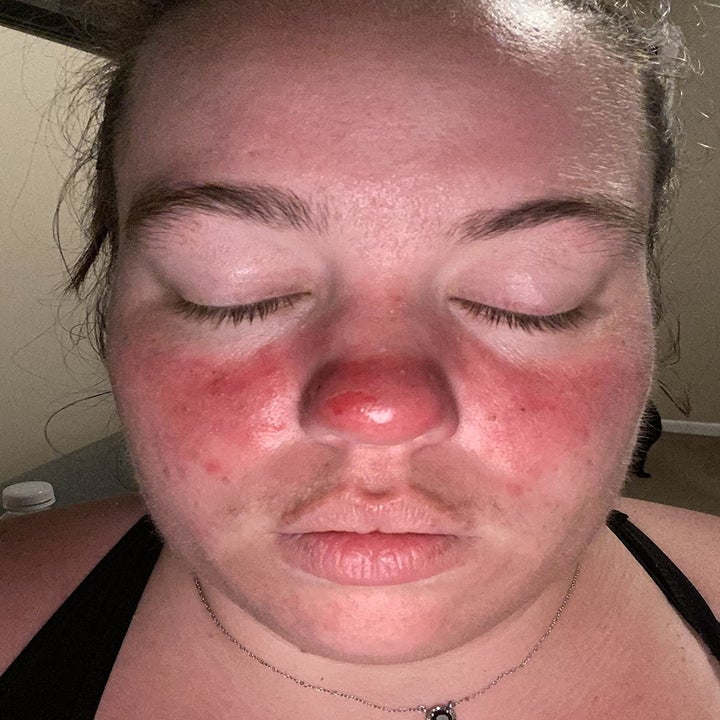 reviewer with rosacea and dark red splotches on their nose and cheeks