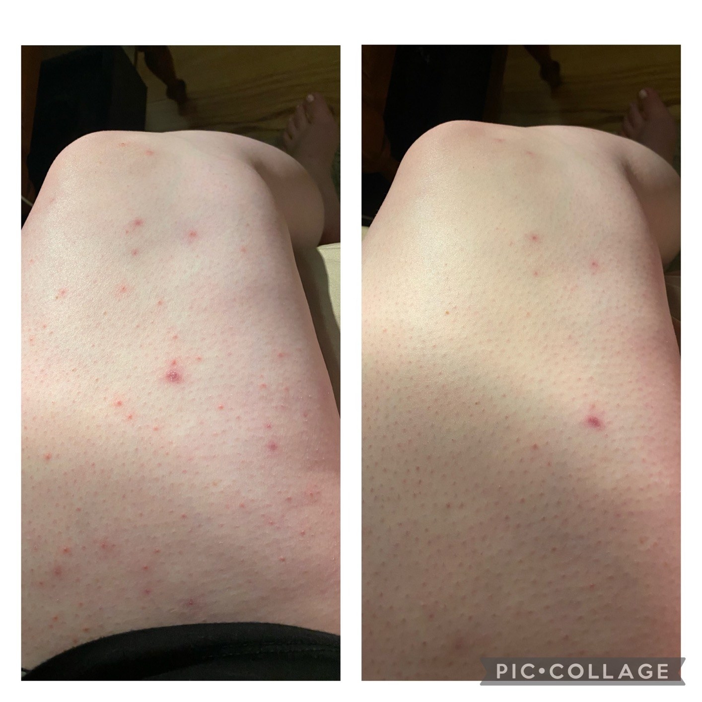 before photo of a reviewer&#x27;s thigh with several ingrown hairs and red irritated bumps next to an after photo of the same reviewer&#x27;s thigh and the red bumps are mostly gone