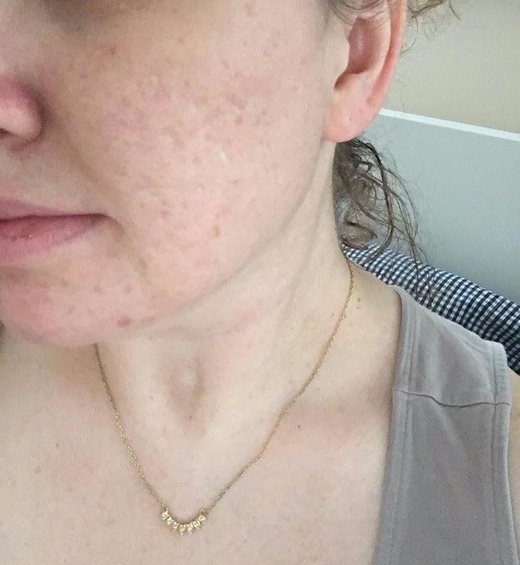 the same reviewer after using the peel consistently and the pitting on their cheeks has lessened dramatically