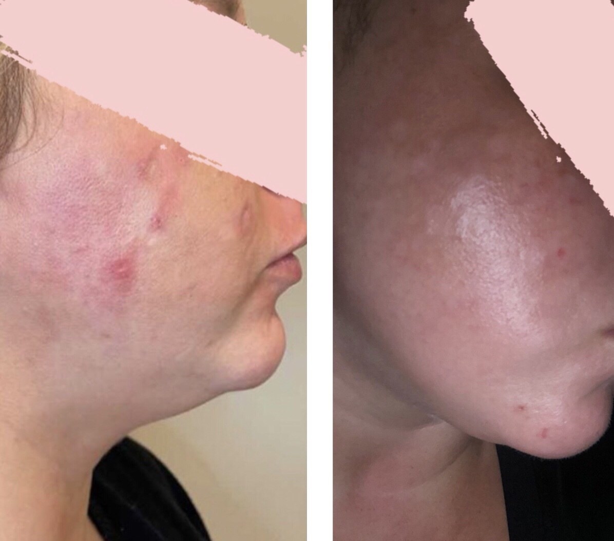 before photo of a reviewer with red splotches and breakouts on their cheek and an after photo of the same cheek, which looks less irritated and has fewer acne scars