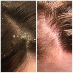 reviewer with flaky then clear scalp