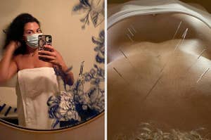 an image of the author getting ready for acupuncture next to acupuncture needles in a back