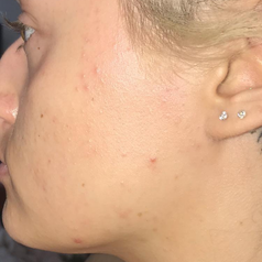 reviewer's face with peach fuzz removed and skin looking smoother