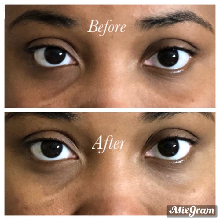 before and after showing the eye masks helped reduce dark circles under a user's eyes