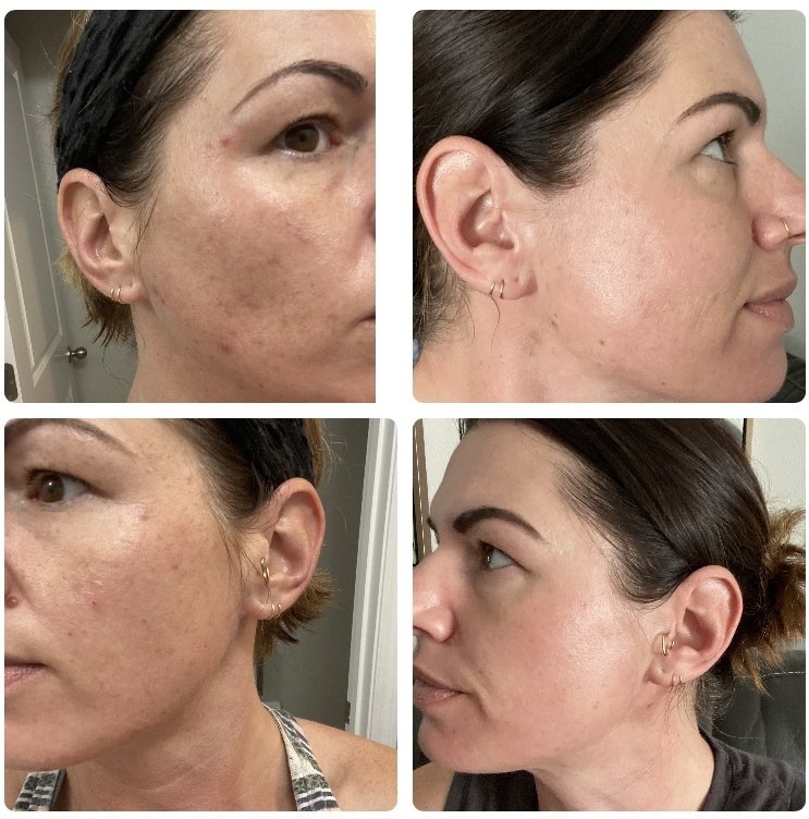 side by side of reviewer&#x27;s face showing the retinol made their complexion look brighter, faded dark spots, and tightened their skin