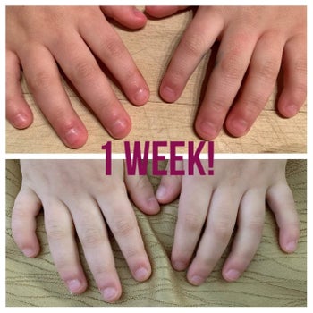 Reviewer's before photo showing their child's bitten fingernails and after photo showing the improvement in their nails after a week of using the pen