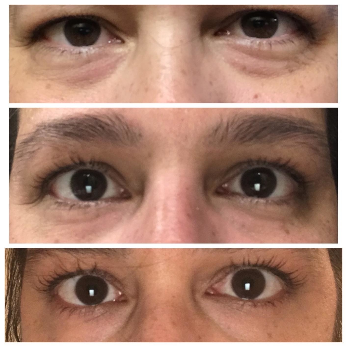 A reviewer&#x27;s progress using the eye cream in three images, showing reduces puffiness and dark circles