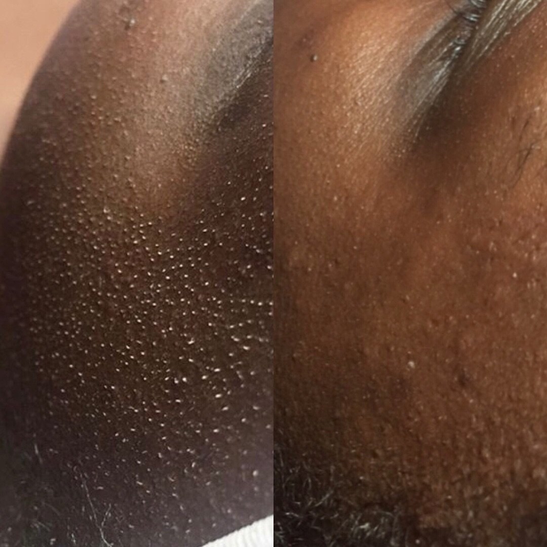 before and after images of dead skin and clogged pores disappearing from someone&#x27;s face