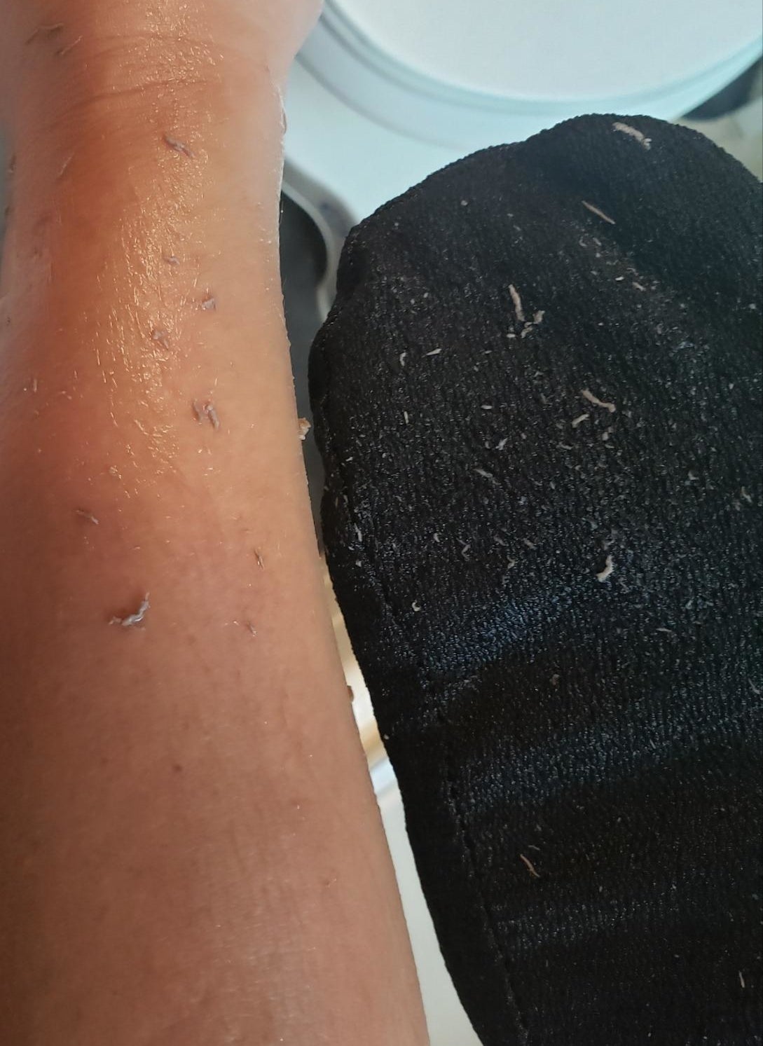 image of dead skin falling off reviewer&#x27;s arm