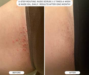 a split image of a reviewer before and after using the oil with the look of razor bumps drastically reduced after a month