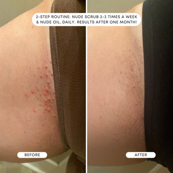 a split image of a reviewer before and after using the oil with the look of razor bumps drastically reduced after a month
