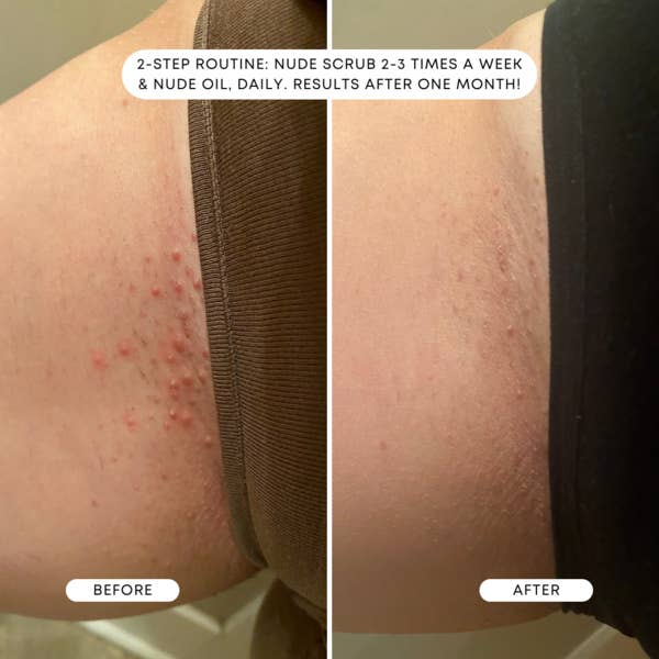 a reviewer before and after using the oil with the look of razor bumps drastically reduced after a month