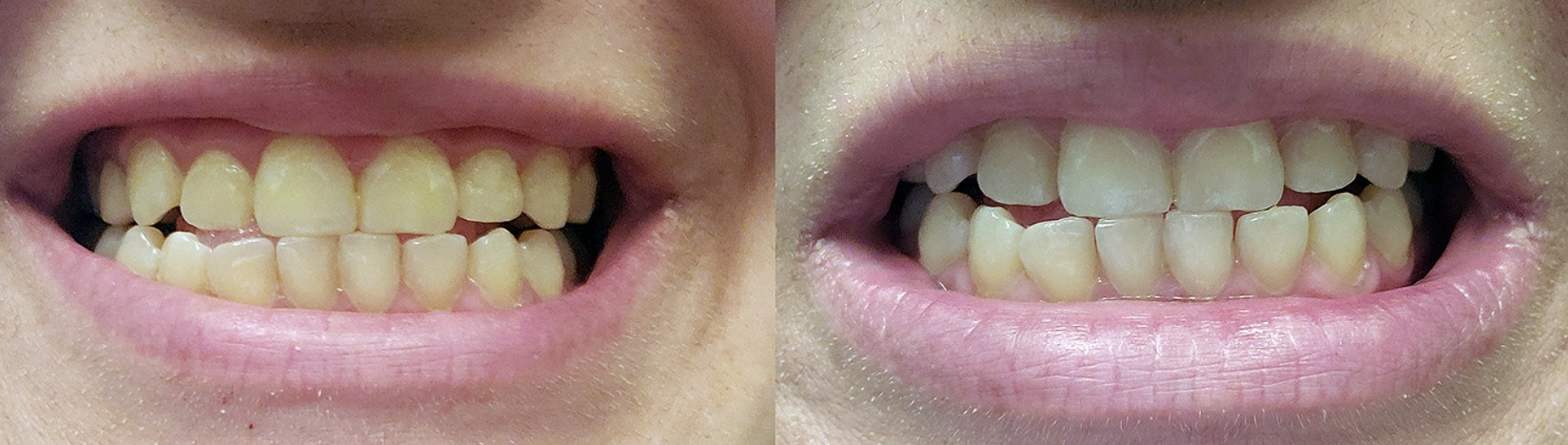 before photo of a reviewer&#x27;s yellow teeth and after photo showing the pen significantly brightened their teeth