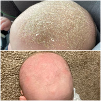 Reviewer's before photo of a baby's head with dry scales and after photo of the same baby's head looking smoother and flake-free