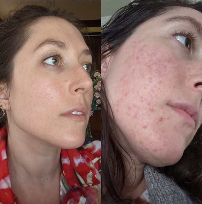 a reviewer&#x27;s before and after showing their skin clearing up