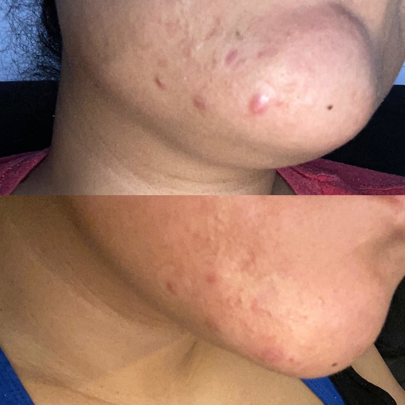reviewer image of a before and after with pimples on the chin and smaller bumps after using the pimple patches