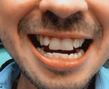 the same reviewer's teeth showing less plaque after using the waterpik