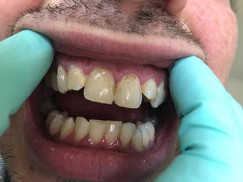 before photo of a reviewer's teeth and you can see plaque along their gumline