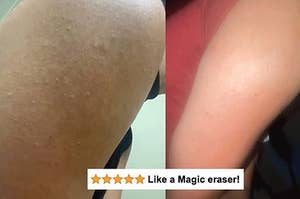 A reviewer's before/after showing the bumpy skin that's now smooth with five-star review text "like a magic eraser"