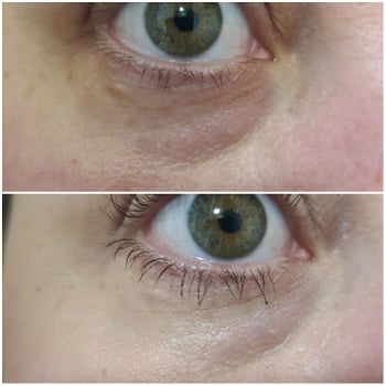 Reviewer's under-eye area before and after using L'Oreal concealer