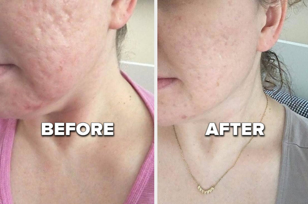 L: reviewer with acne scars and pitted skin on their cheek R: the same reviewer with noticeably smoother skin after using glycolic acid peel
