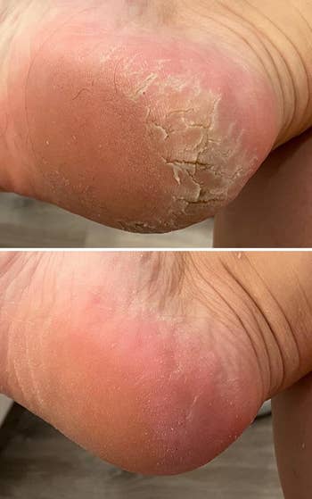 A before and after of a reviewer's feet after using the foot file - the top photo has dry cracked heels, while the bottom is smooth and soft-looking