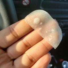 photo of pimple gunk from a reviewer's pimple patch