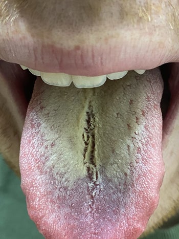 reviewer's tongue covered in nasty grayish buildup