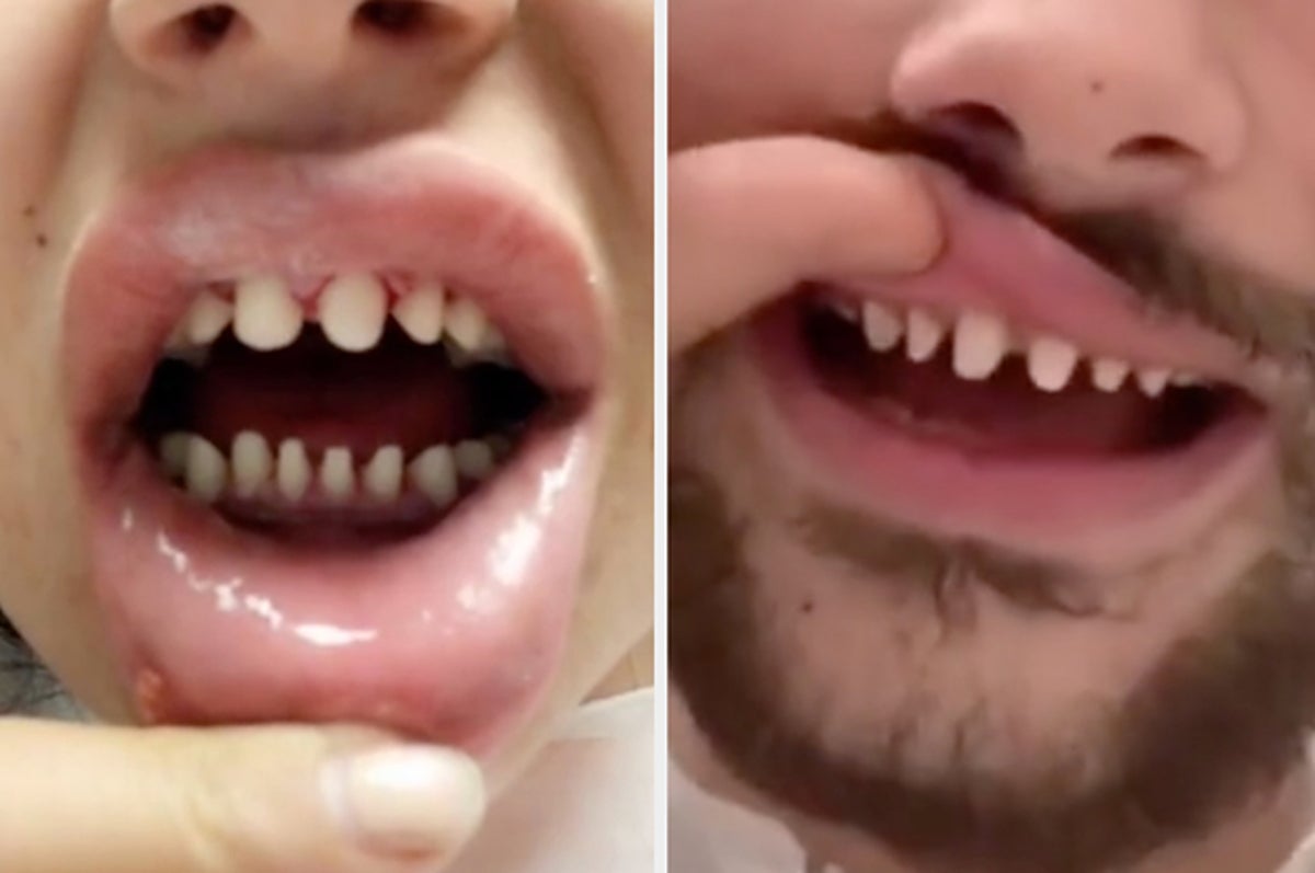 teeth veneers