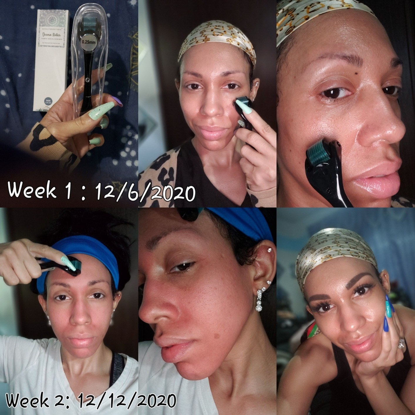 A reviewer demonstrating use of the derma-roller and progress pics over the course of two weeks, the end result being a smooth, dewy-looking face