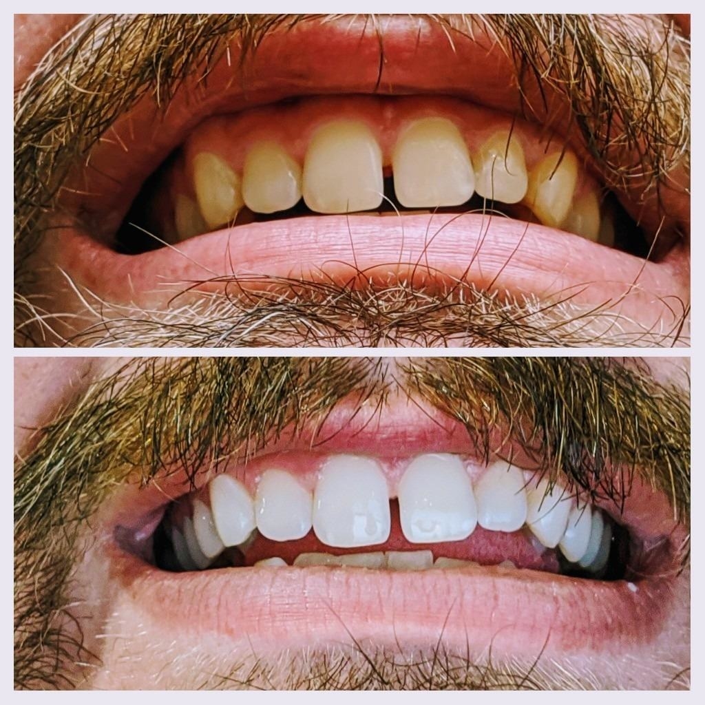 before and after reviewer images of yellow teeth becoming white
