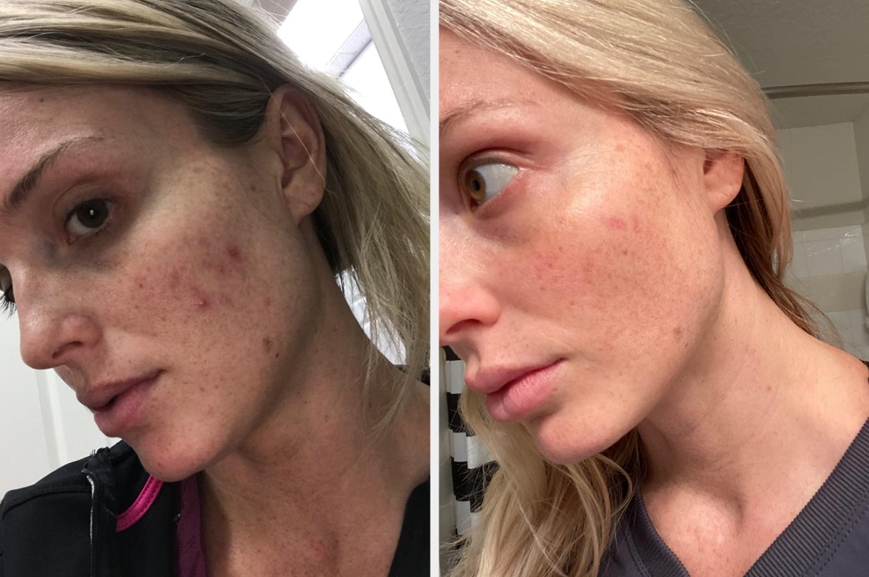 A reviewer&#x27;s before and after photos after using the Cosrx snail mucin cream, with dull skin and acne on the left and visibly smoother and brightened skin on the right