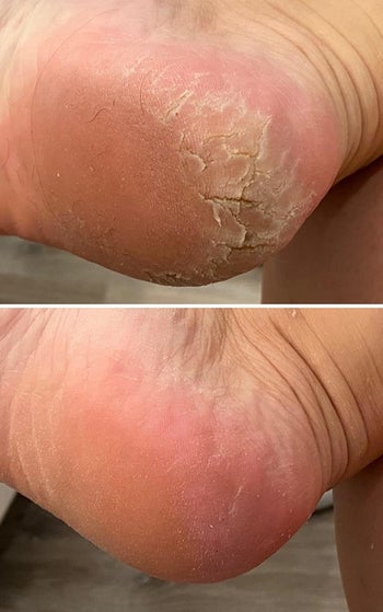 Reviewer's foot before and after using foot file