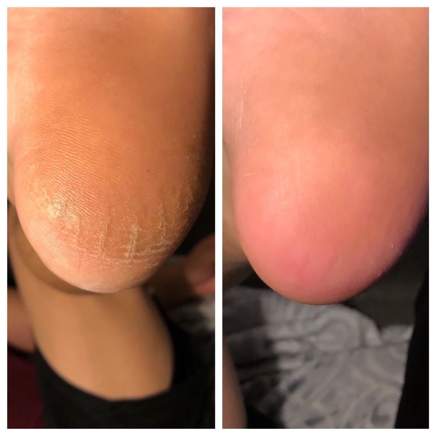 Reviewer before and after showing a dry, cracked heel followed by a smooth one