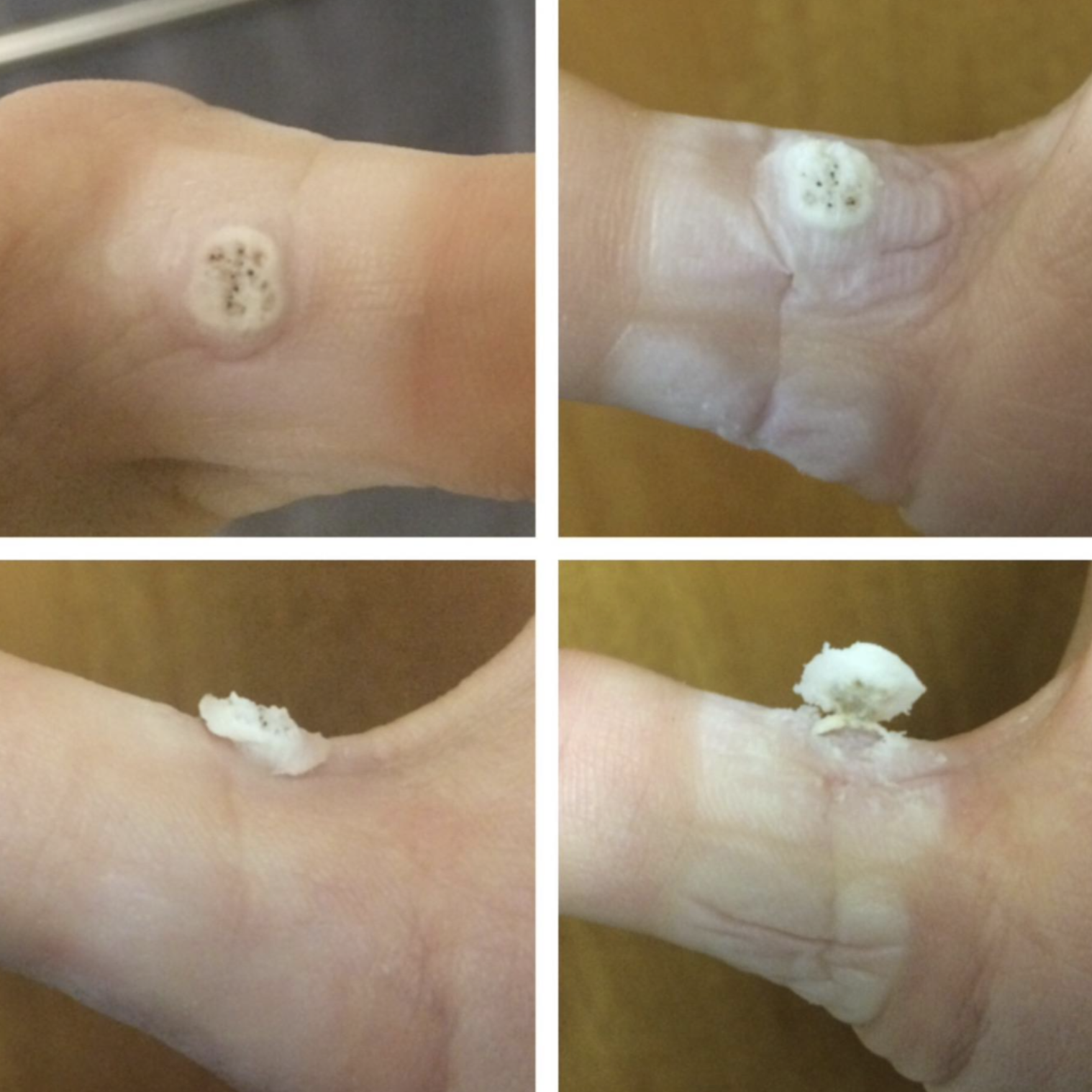 Reviewer&#x27;s progression photos showing the pads removed a wart on their finger
