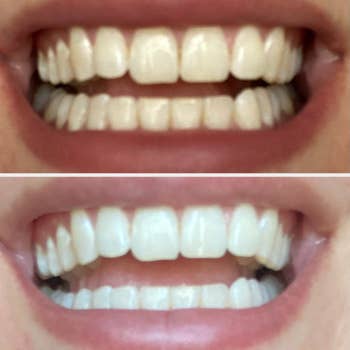 A before and after - the top photo is a person with slightly yellow teeth; the bottom photo shows their teeth whitened after using the pen