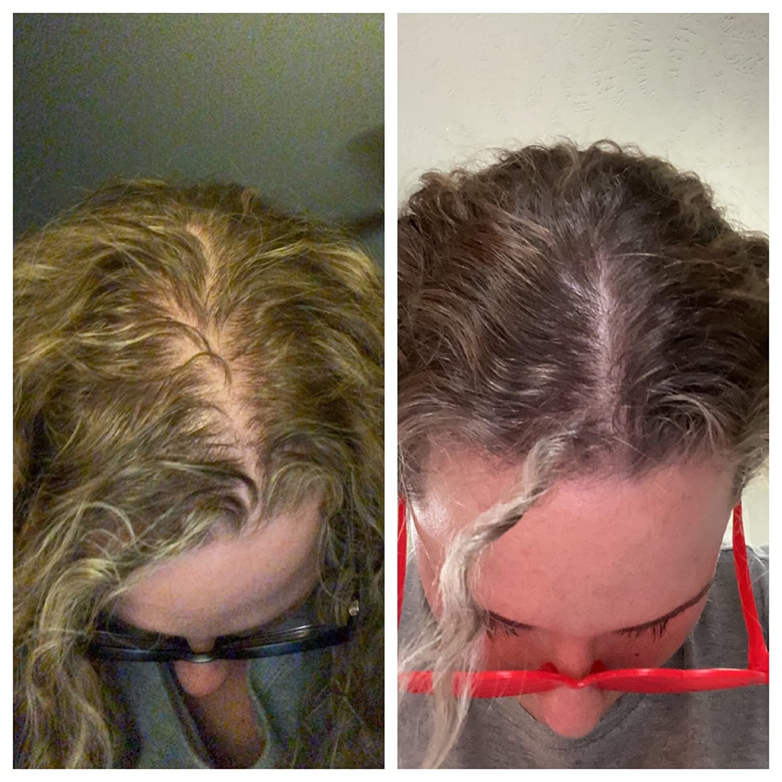 On left, a reviewer showing a bald spot on their head, and on the right, the same reviewer now showing hair starting to grow where the bald spot was