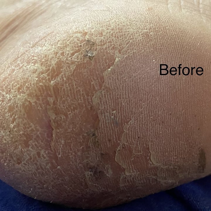 Reviewer before photo of their dry, cracked heel