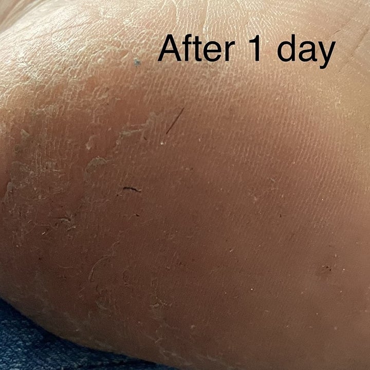 The same reviewer's after photo showing a smoother heel after one application