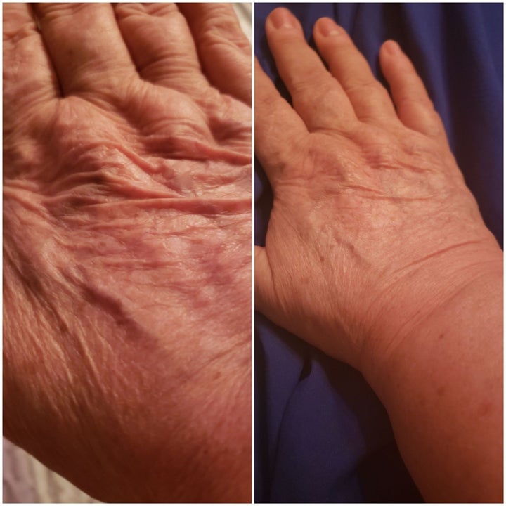 Reviewer before and after photos showing large wrinkles on their hand (left) and fewer wrinkles on their hand (right)
