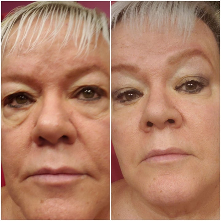 Reviewer before and after photos showing large bags under their eyes (left) and a firmer under-eye appearance (right)