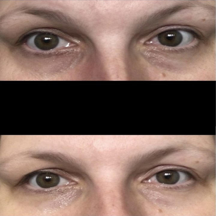 Reviewer before and after photos showing dark under-eye circles (top) and brighter under-eyes (bottom)