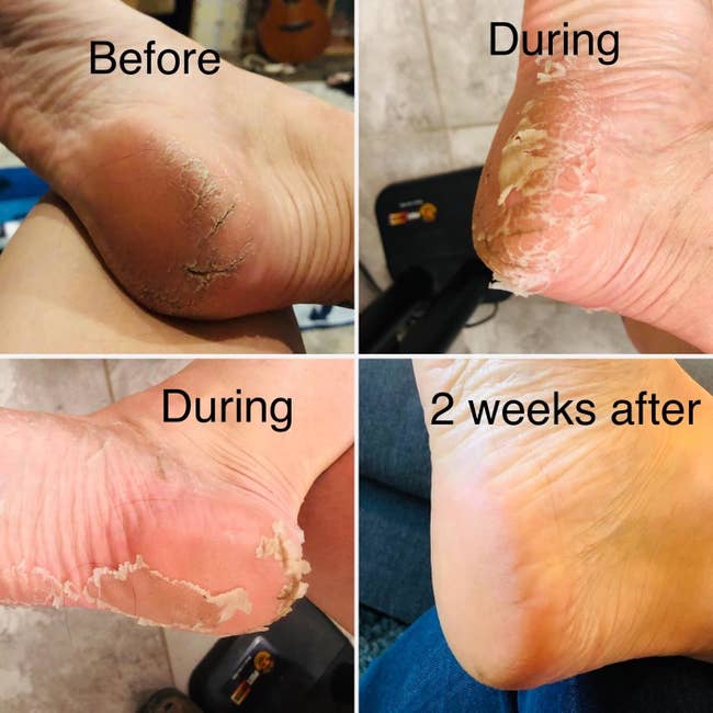 A reviewer's cracked foot before, peeling skin during, and smooth foot after using the peel
