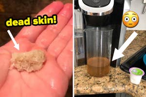 A split thumbnail of dead skin and a Keurig