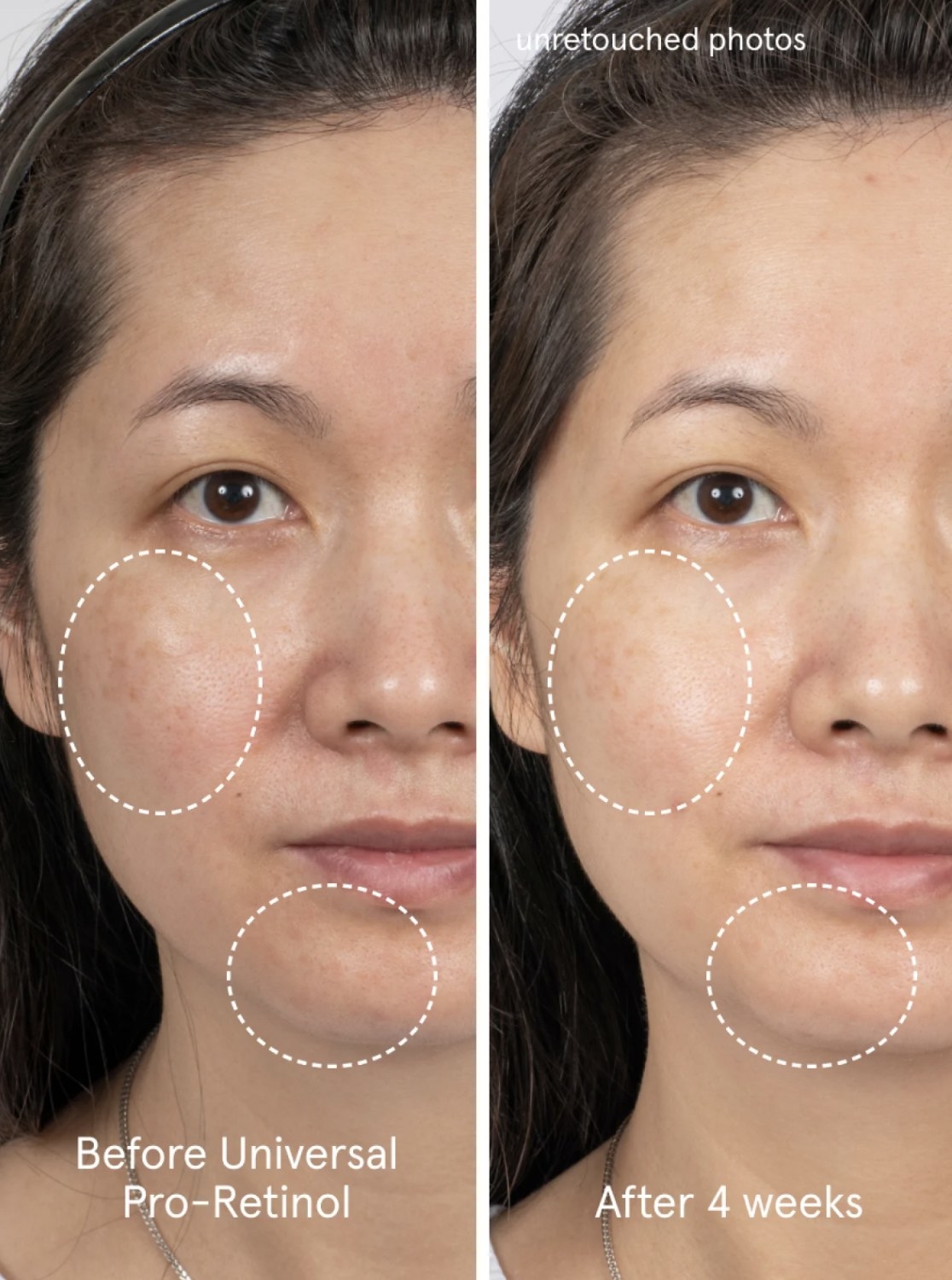 a before and after of a person with dark spots, and then visibly less dark spots after four weeks