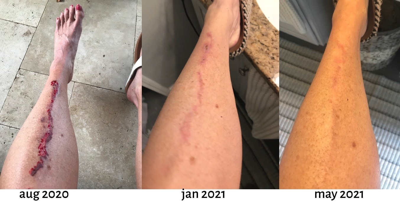 reviewer&#x27;s large leg scar in august 2020, then it majorly faded in january 2021, then even more faded in may