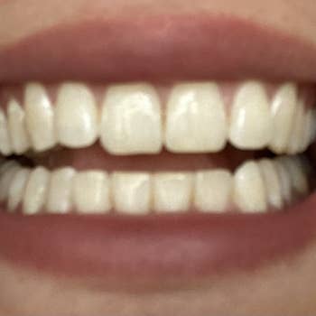 Reviewer's teeth before using the pen